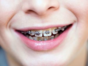 Crooked Teeth- Causes and Solutions